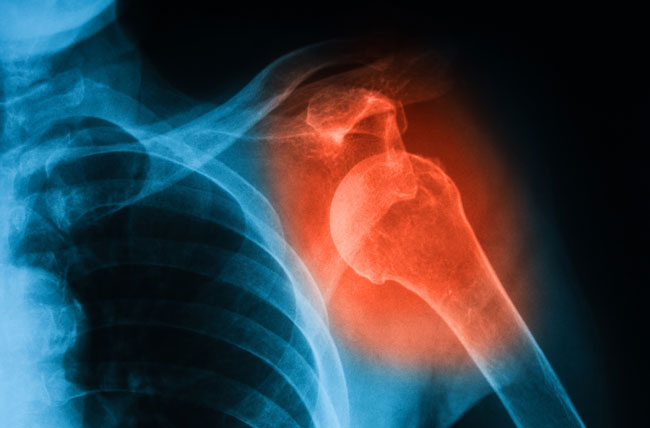 Joint Dislocation Symptoms And Causes